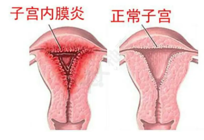 全自动阴道分泌物香蕉视频黄污下载厂家子宫内膜炎的症状表现提前了解与预防