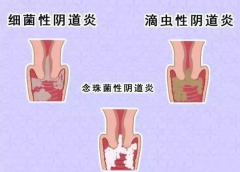 全自动阴道分泌物香蕉视频黄污下载厂家提醒您还在拖延吗，还在等阴道炎自愈吗？